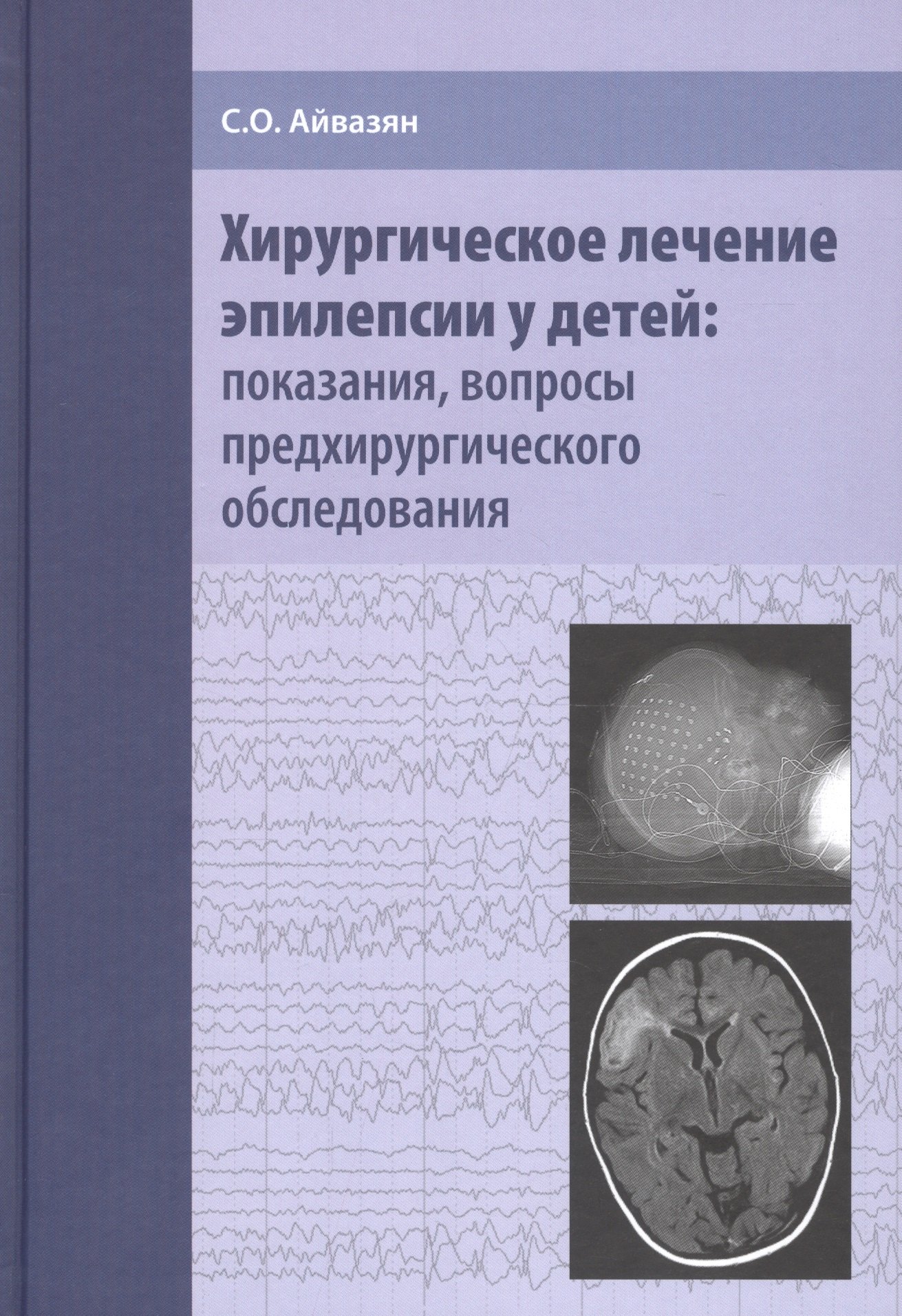 Хирургическое лечение эпилепсии у детей: показания, вопросы предхирургического обследования
Хирургическое лечение эпилепсии у детей: показания, вопросы предхирургического обследования