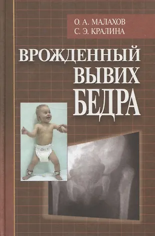 Врождённый вывих тазобедренного сустава. Дисплазия тазобедренных суставов врожденная: Лечение Дисплазия. Коксартроз - причины появления, симптомы заболевания, диагностика и. Вывих тазобедренного сустава. Не допустите последствий | Просто о.