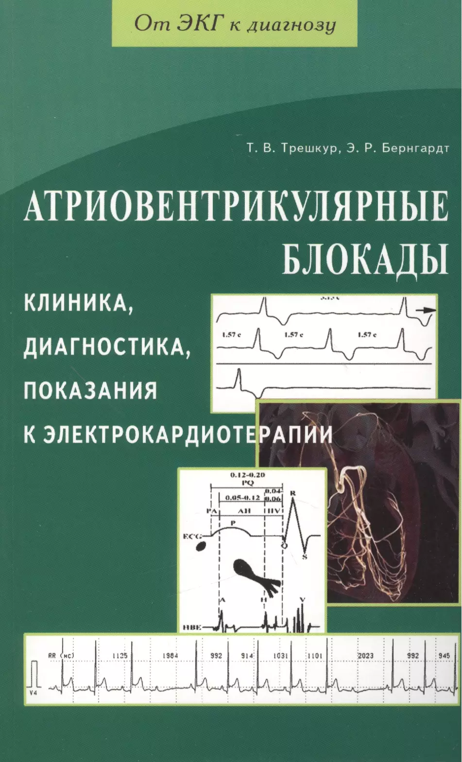  - Атриовентрикулярные блокады. Клиника, диагностика, показания к электрокардиотерапии