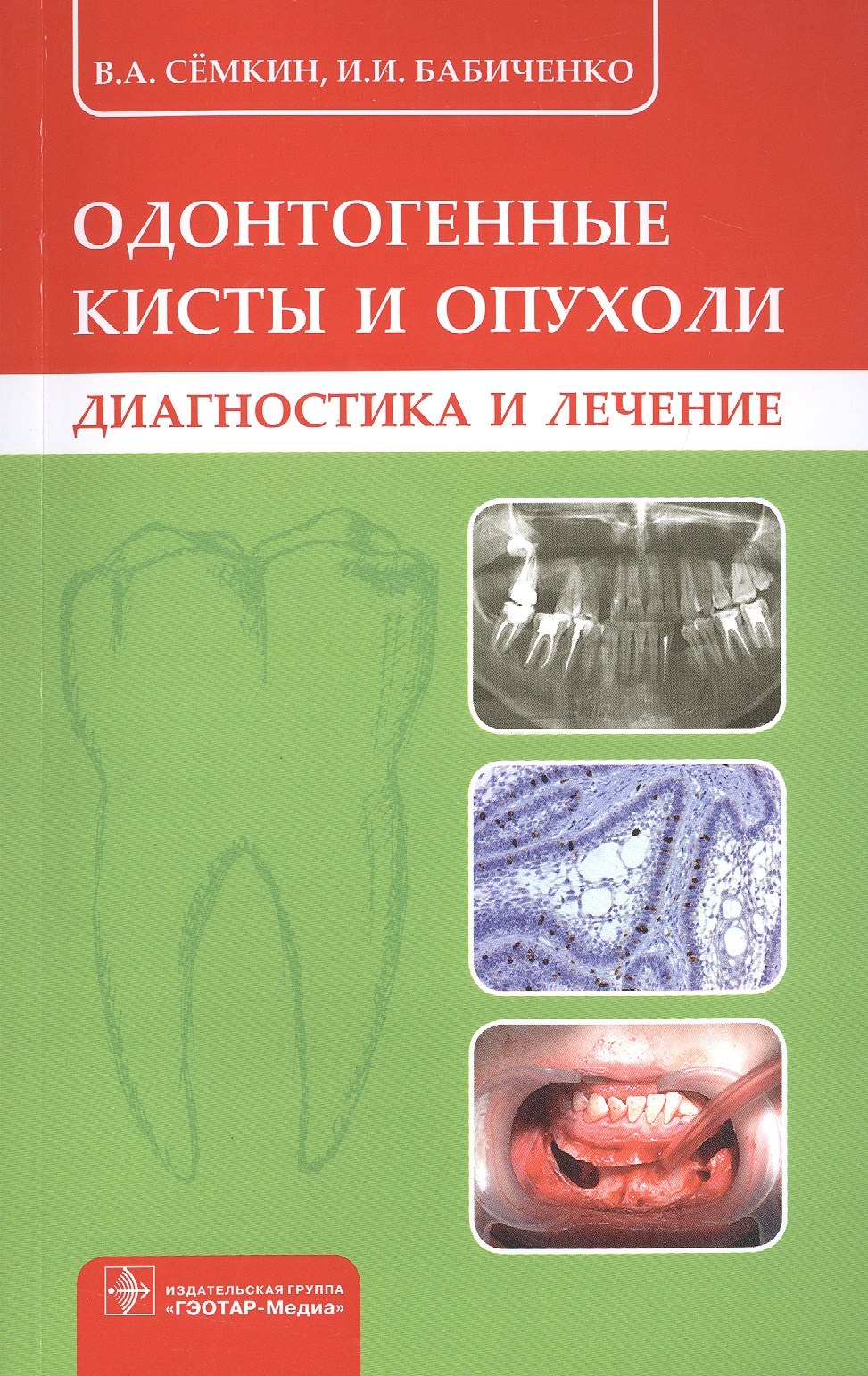 

Одонтогенные кисты и опухоли. Диагностика и лечение