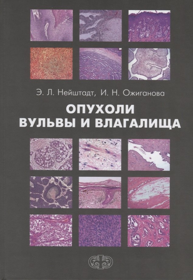 

Опухоли вульвы и влагалища