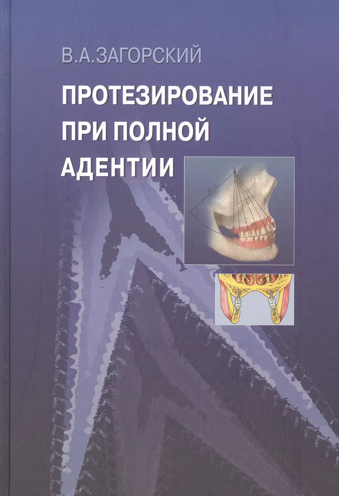 Загорский Валерий Арсентьевич - Протезирование при полной адентии.