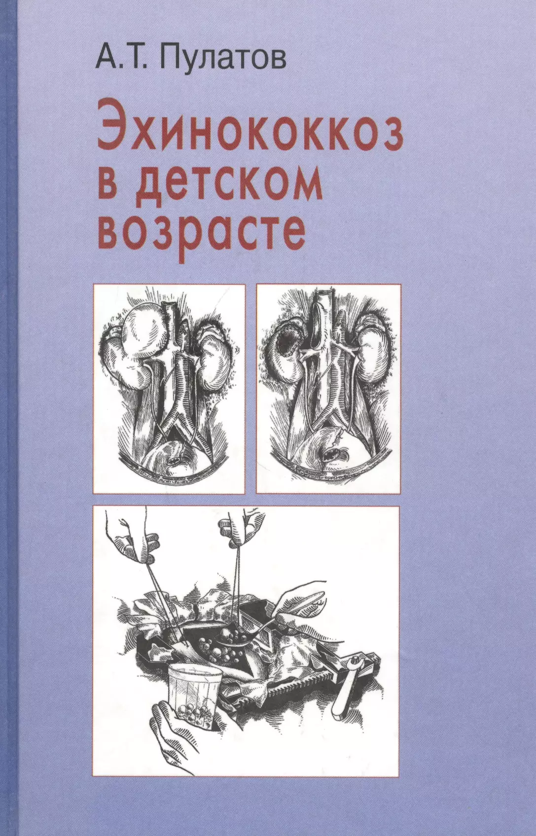  - Эхинококкоз в детском возрасте