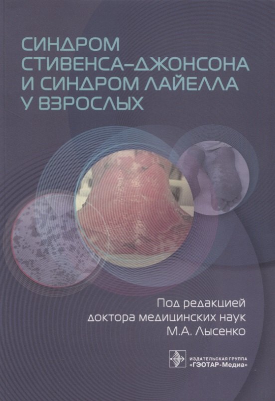 

Синдром Стивенса–Джонсона и синдром Лайелла у взрослых
