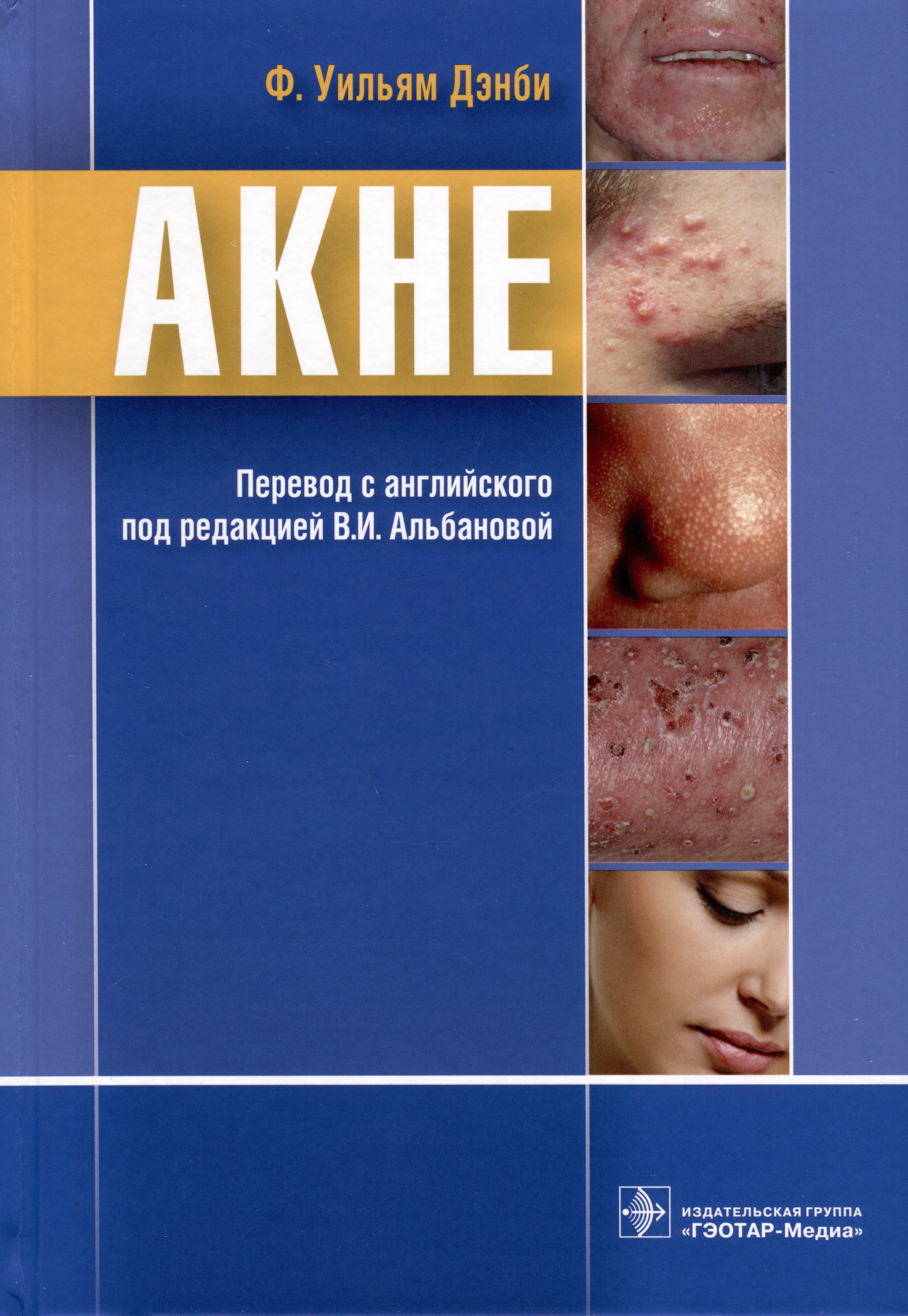 

Акне